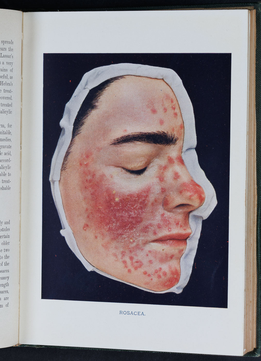 <center> Norman Walker <p> Introduction to DERMATOLOGY <br><i> Colored Plates </i><br> 1908 </center>